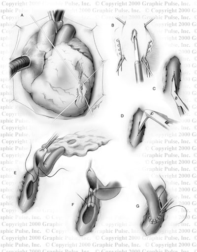 Heart surgery medical illustration