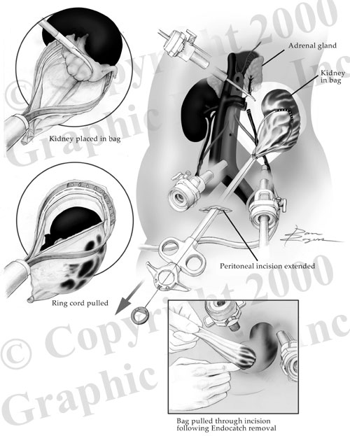 Kidney surgical medical illustration